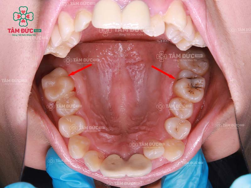 Răng số 6 thuộc nhóm răng hàm lớn có bề mặt nhai rộng