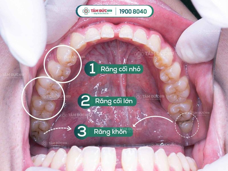 Hiện tượng lợi trùm răng khôn