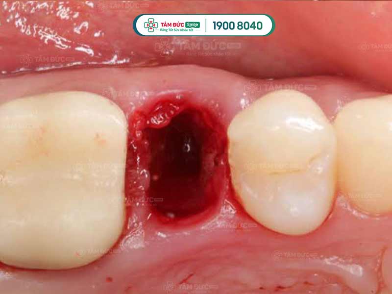 Dấu hiệu ổ răng bị khô viêm