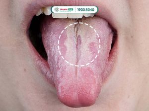 Nấm miệng ở lưỡi