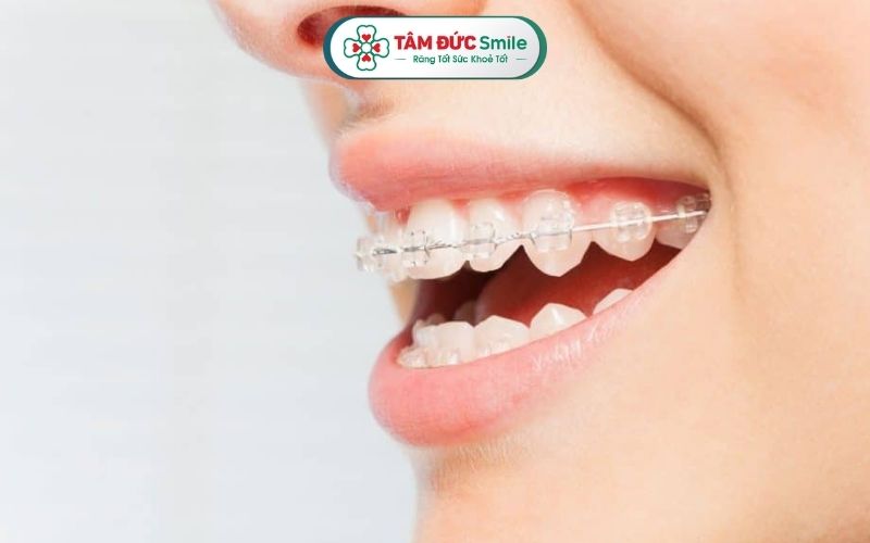 Nẹp răng còn được gọi là chỉnh nha, là phương pháp điều chỉnh vị trí của răng để giúp khớp cắn đều đặn