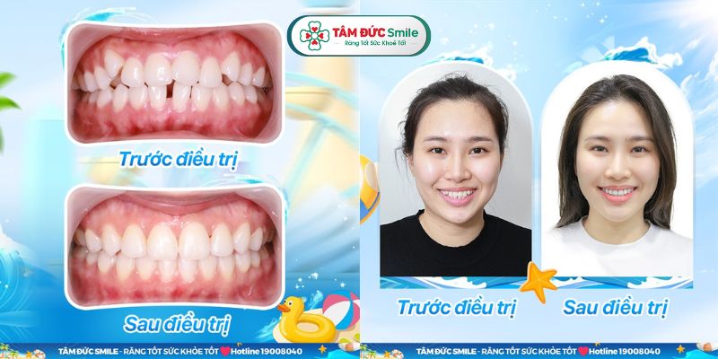 Nha khoa Tâm Đức Smile áp dụng quy trình nẹp răng chuẩn y khoa, mang lại hiệu quả cao