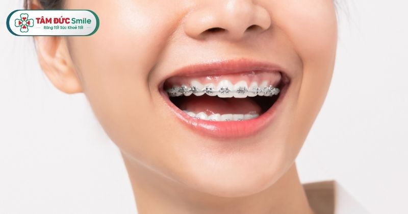 Nẹp răng còn được gọi là chỉnh nha, là phương pháp điều chỉnh vị trí của răng để giúp khớp cắn đều đặn