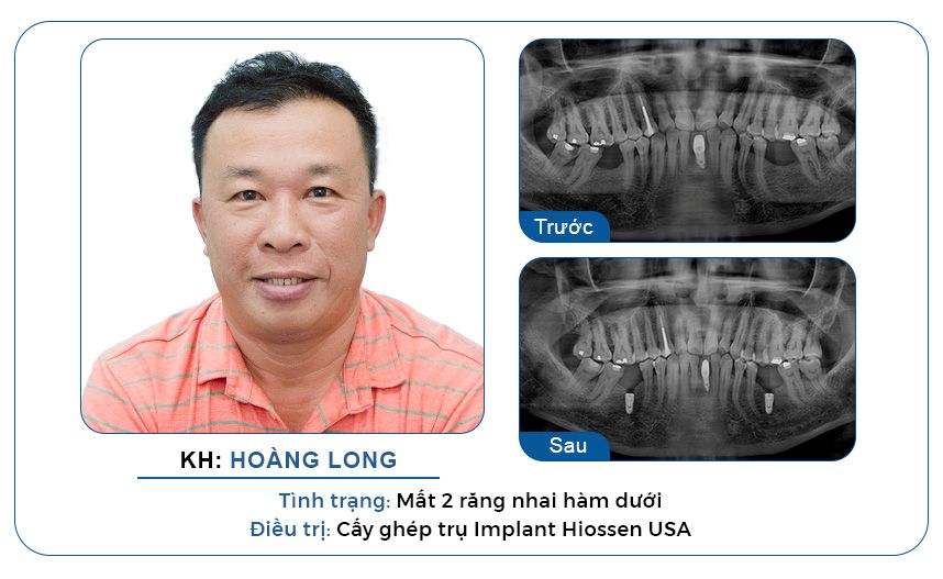 ca điều trị thực tế của bác sĩ Ngô Minh Trí 