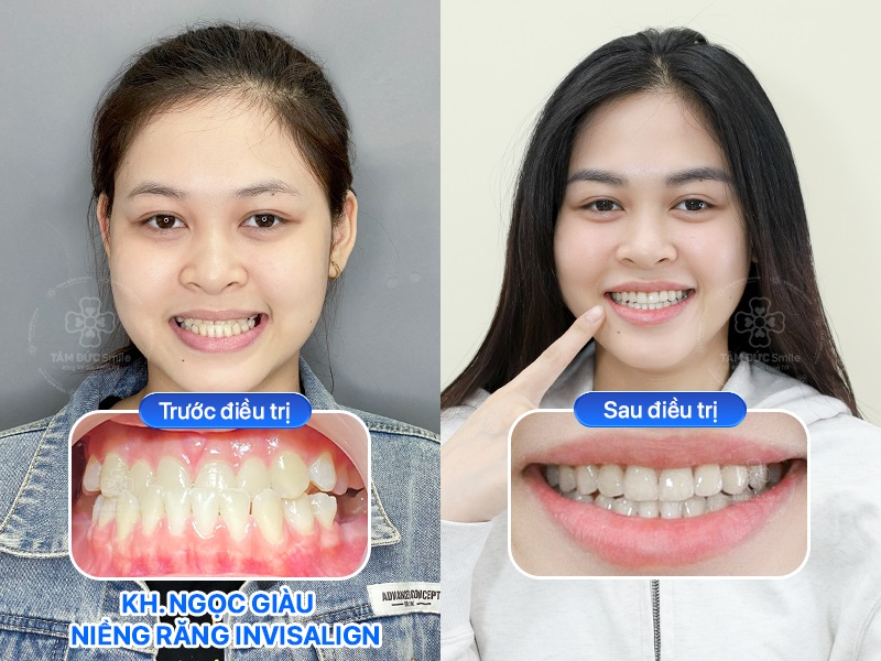Hình ảnh trước và sau niềng răng Invisalign của khách hàng Ngọc Giàu