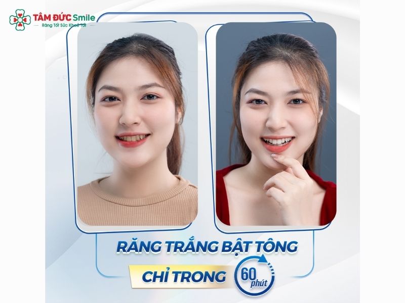 Tẩy trắng răng bằng công nghệ Laser Whitening