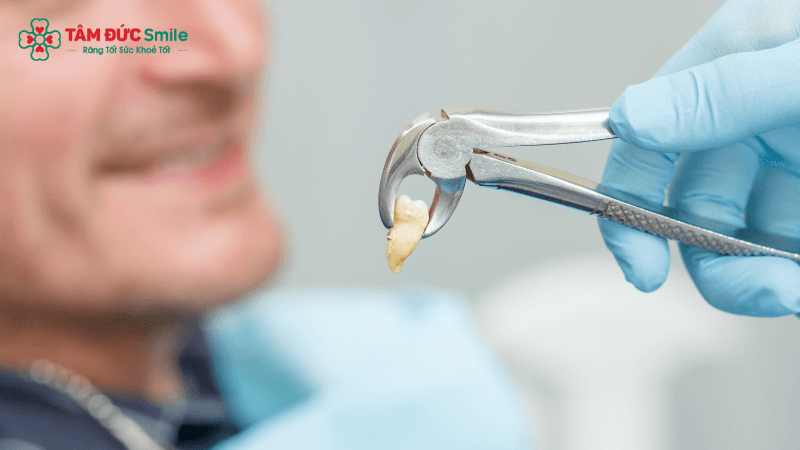 Nhổ răng ngày nay ít đau hơn nhờ công nghệ hiện đại và tay nghề bác sĩ