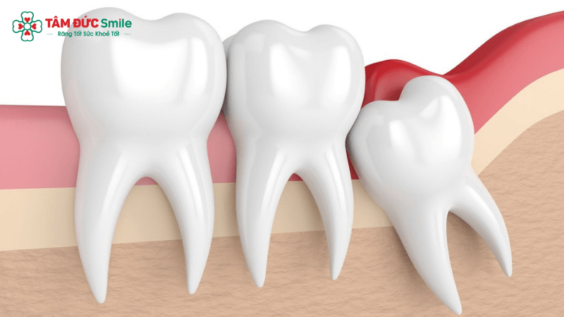 Răng khôn là răng số 8 nằm trong cùng cung hàm, có thể mọc thẳng, mọc lệch hoặc mọc ngầm