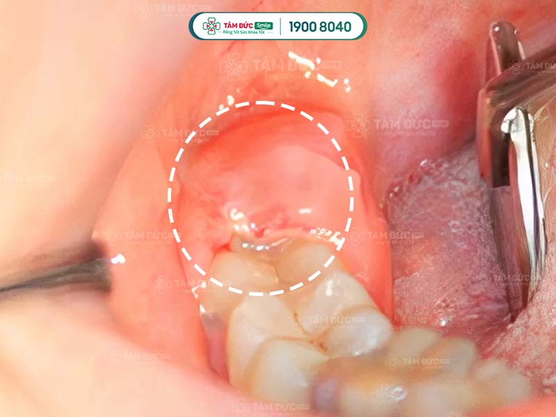 Chấn thương mô mềm có thể gây đau đớn kéo dài