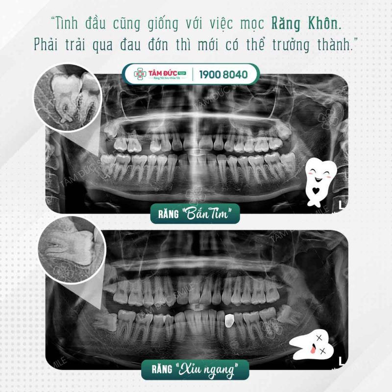 Nhổ răng khôn mất bao lâu?