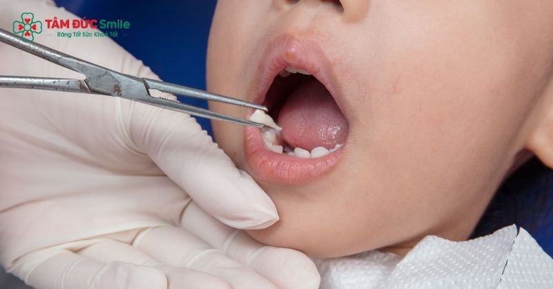 Răng sữa là tiền đề quan trọng cho sự phát triển của răng vĩnh viễn