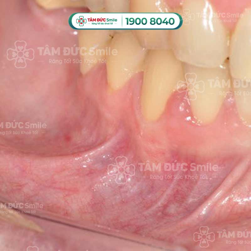 Niêm mạc là phần mô mềm bao phủ bên trong khoang miệng, có lớp biểu mô mềm giúp bảo vệ mô mềm và giữ ẩm khoang miệng