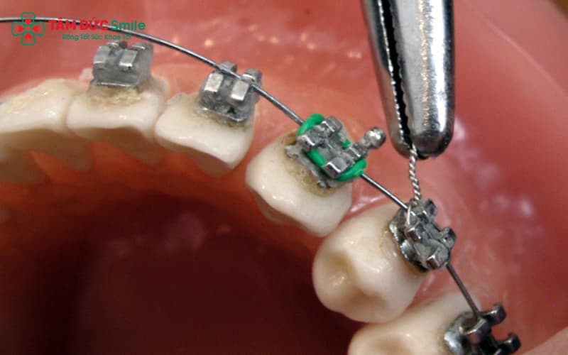 Niềng răng sai kỹ thuật có thể gây đau nhức và cảm giác khó chịu kéo dài