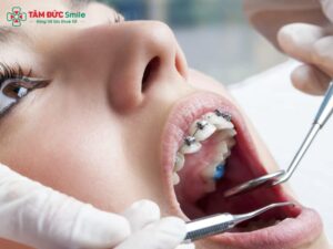Niềng răng có đau không? Mức độ đau – Thời gian đau – Cách giảm đau hiệu quả