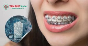 Theo khuyến cáo từ các chuyên gia, Quý khách không nên uống nước đá – đặc biệt là trong 1–2 tháng đầu sau khi niềng răng