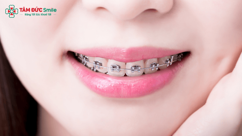 Niềng răng không chỉ giúp răng đều đẹp mà còn cải thiện tỷ lệ khuôn mặt hài hòa hơn