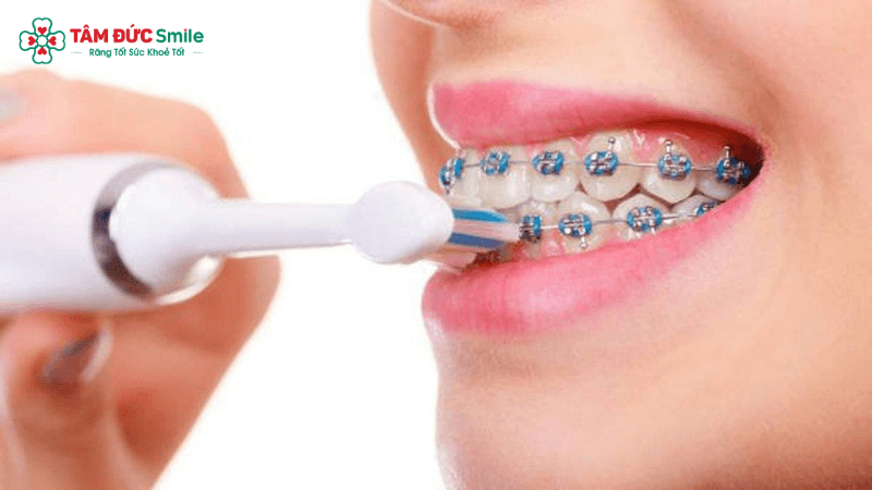 Niềng răng nên dùng bàn chải điện để giảm tổn thương nướu và tiết kiệm thời gian