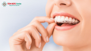 Invisalign – giải pháp niềng răng thẩm mỹ, linh hoạt và giữ nét tự nhiên