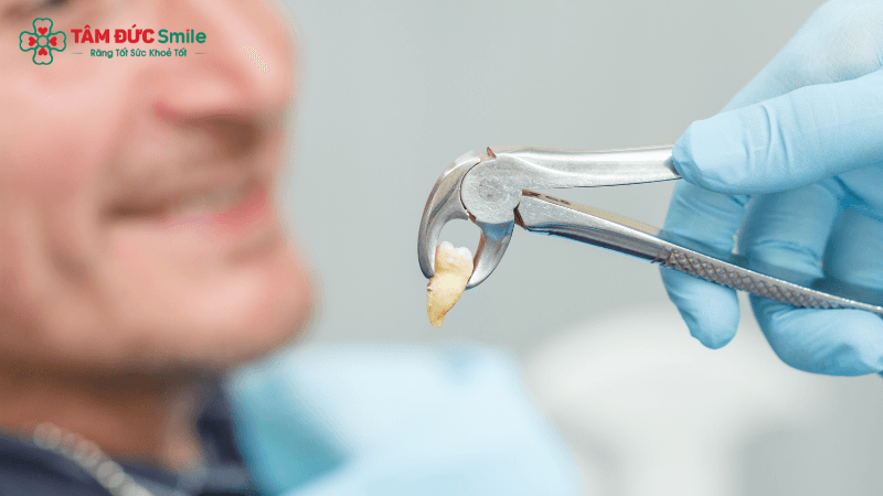Nhổ răng số 4 hoặc 5 để tạo khoảng sẽ được gây tê, không gây đau