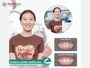 nieng-rang-invisalign-tai-tphcm-7