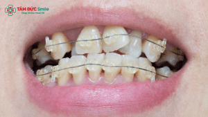 Răng lệch lạc, không đều