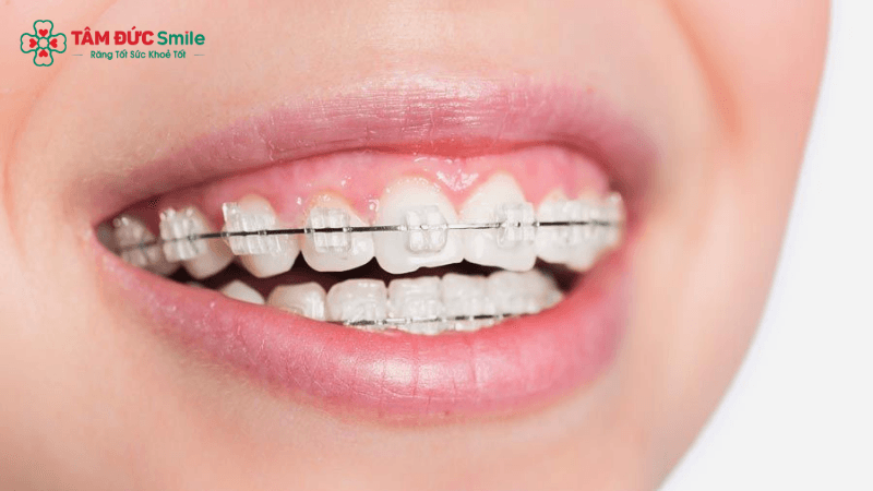 Niềng răng mắc cài sứ