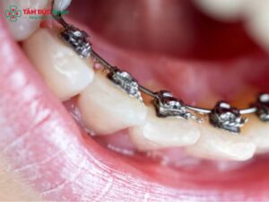 Niềng răng mặt trong có đau không? Giá bao nhiêu? Ưu – nhược điểm & công nghệ mới