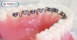 Niềng răng mặt trong là kỹ thuật chỉnh nha "vô hình" - sự lựa chọn lý tưởng cho người trưởng thành