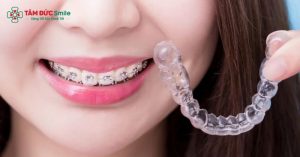 thời gian niềng răng trung bình thường dao động từ 12 – 24 tháng