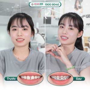 Niềng răng thưa là kỹ thuật chỉnh nha thẩm mỹ thích hợp với tất cả mọi đối tượng