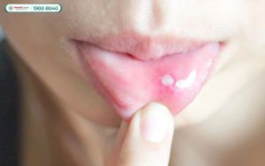 Nổi đẹn là một dạng viêm loét niêm mạc miệng