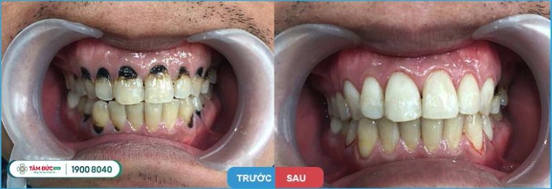 Ca trám răng sâu cổ răng tại Nha khoa Tâm Đức Smile