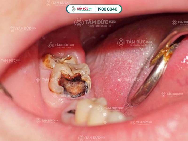 Răng bị sâu đổi màu