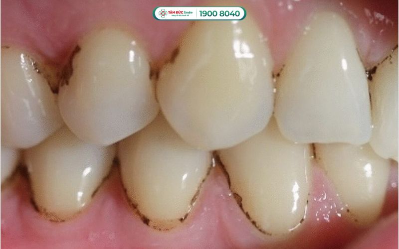 Răng bị đen ở kẽ là tình trạng mà kẽ răng xuất hiện các đốm đen nhỏ