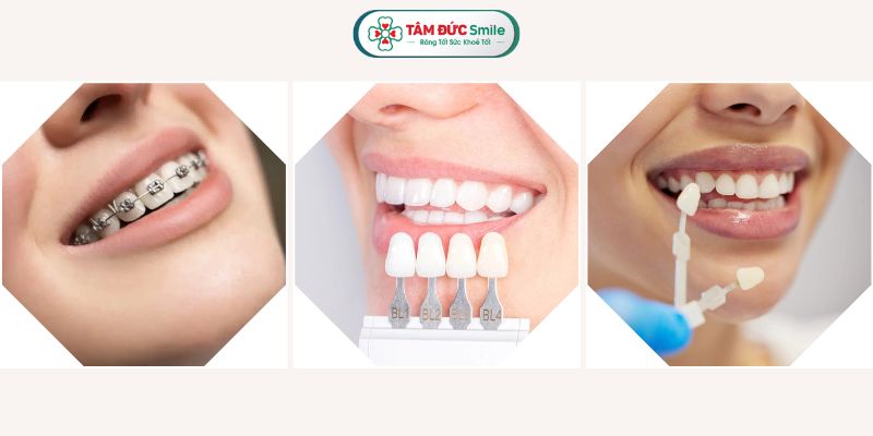 Bạn có thể sở hữu hàm răng đẹp bằng cách niềng răng, bọc răng sứ, dán sứ Veneer