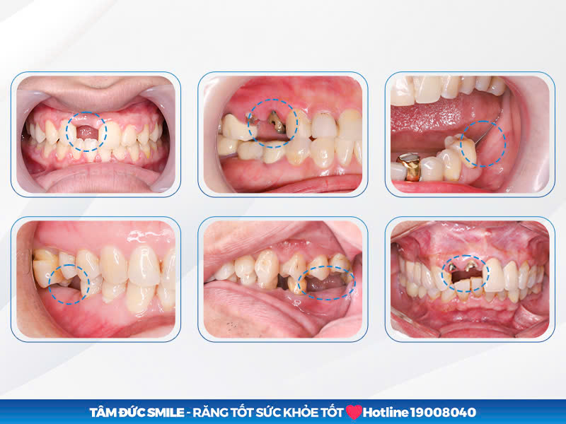 Các trường hợp gãy và mất răng phổ biến