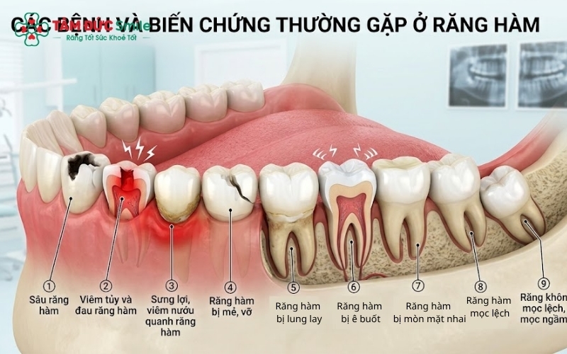 Minh hoạ chi tiết các bệnh và biến chứng thường gặp ở răng hàm 