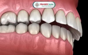 Răng hô nhẹ là tình trạng lệch khớp cắn phổ biến