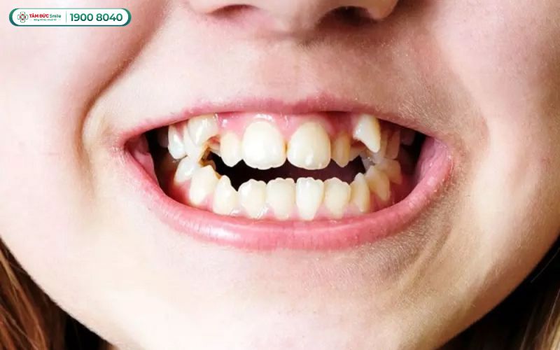 Răng khểnh là chiếc răng nanh mọc lệch so với những răng còn lại