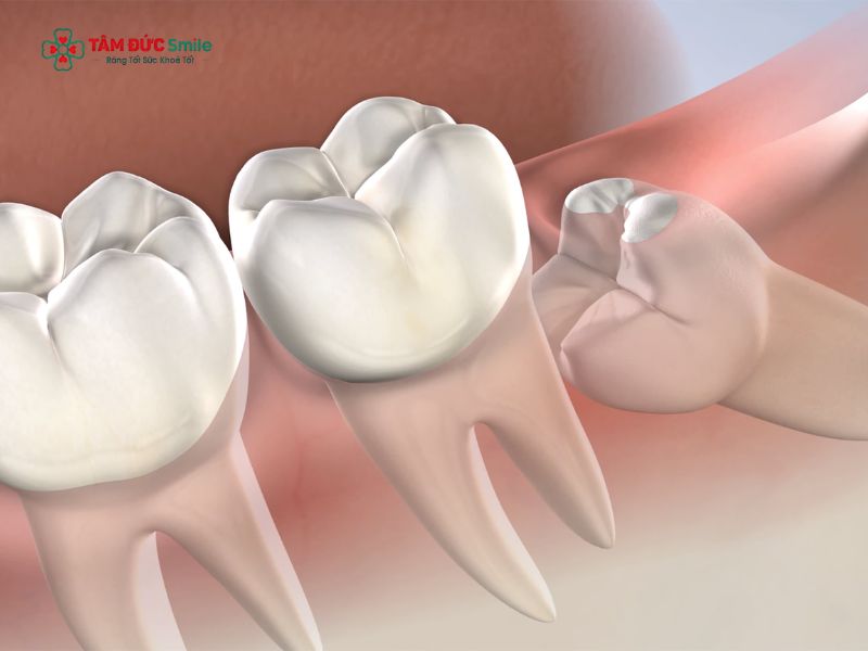Răng khôn mọc lệch, viêm lợi trùm hoặc ảnh hưởng răng số 7 cần được bác sĩ Nha khoa Tâm Đức Smile kiểm tra.