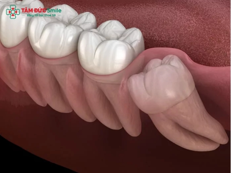 Răng khôn mọc lệch: Dấu hiệu, biến chứng và cách xử lý an toàn