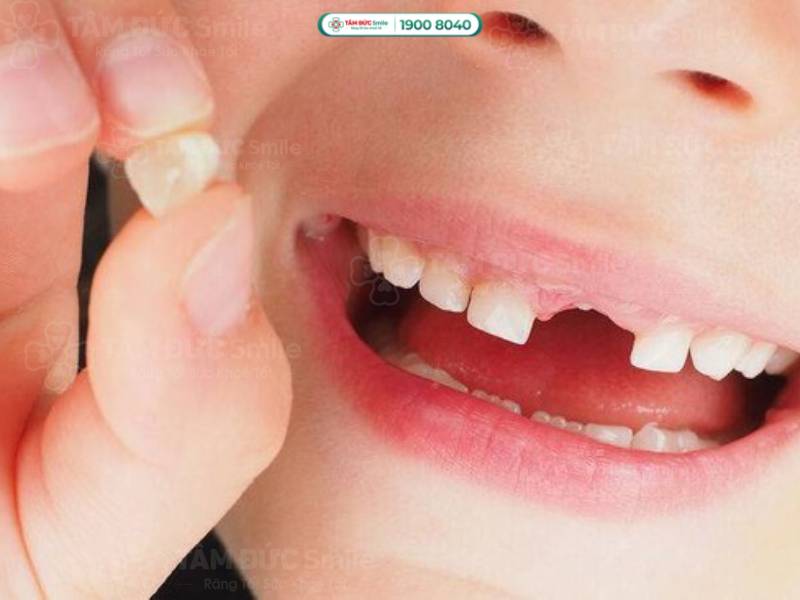 Trẻ bắt đầu thay răng sữa ở khoảng 6-7 tuổi