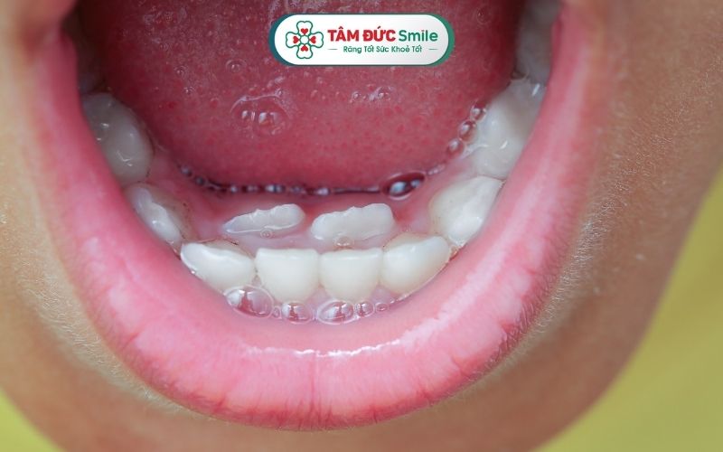 Răng mọc lẫy là hiện tượng khá phổ biến ở trẻ em, tức là răng vĩnh viễn mọc lệch khỏi vị trí bình thường