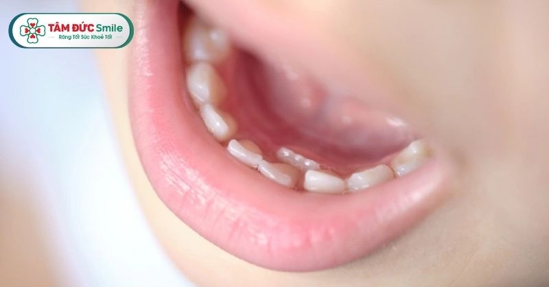 Trẻ bị răng mọc lẫy là tình trạng răng vĩnh viễn mọc lệch vào trong hoặc ra ngoài khi răng sữa chưa rụng