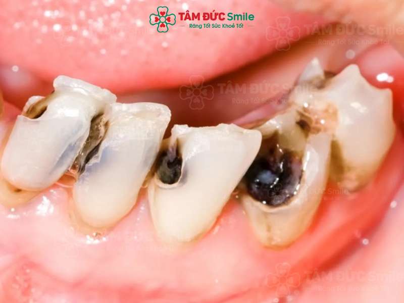 Răng bị sâu nghiêm trọng sẽ cần phải điều trị tủy để bảo tồn chức năng răng
