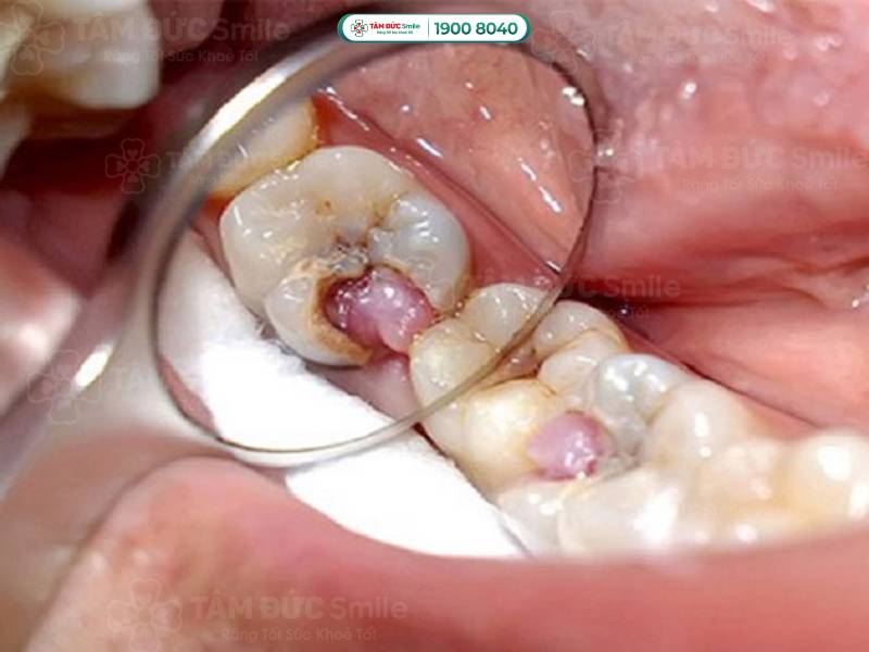Răng sâu lồi thịt có thể nhổ bỏ được