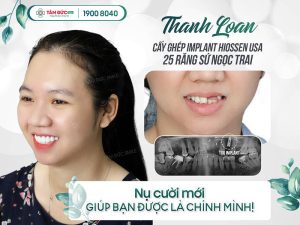 Răng sứ ngọc trai Pearl Smile là dòng răng sứ thẩm mỹ cao cấp được nhiều khách hàng lựa chọn khi muốn cải thiện màu răng trắng tự nhiên