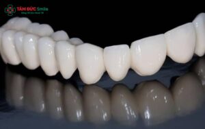 Răng toàn sứ Emax Press có tính thẩm mỹ tự nhiên, nụ cười hoàn hảo