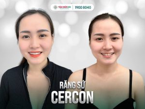 Răng sứ Cercon mang vẻ đẹp tinh tế