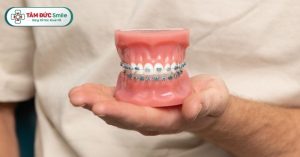 Siết răng là một thao tác quan trọng trong quá trình niềng răng thẩm mỹ
